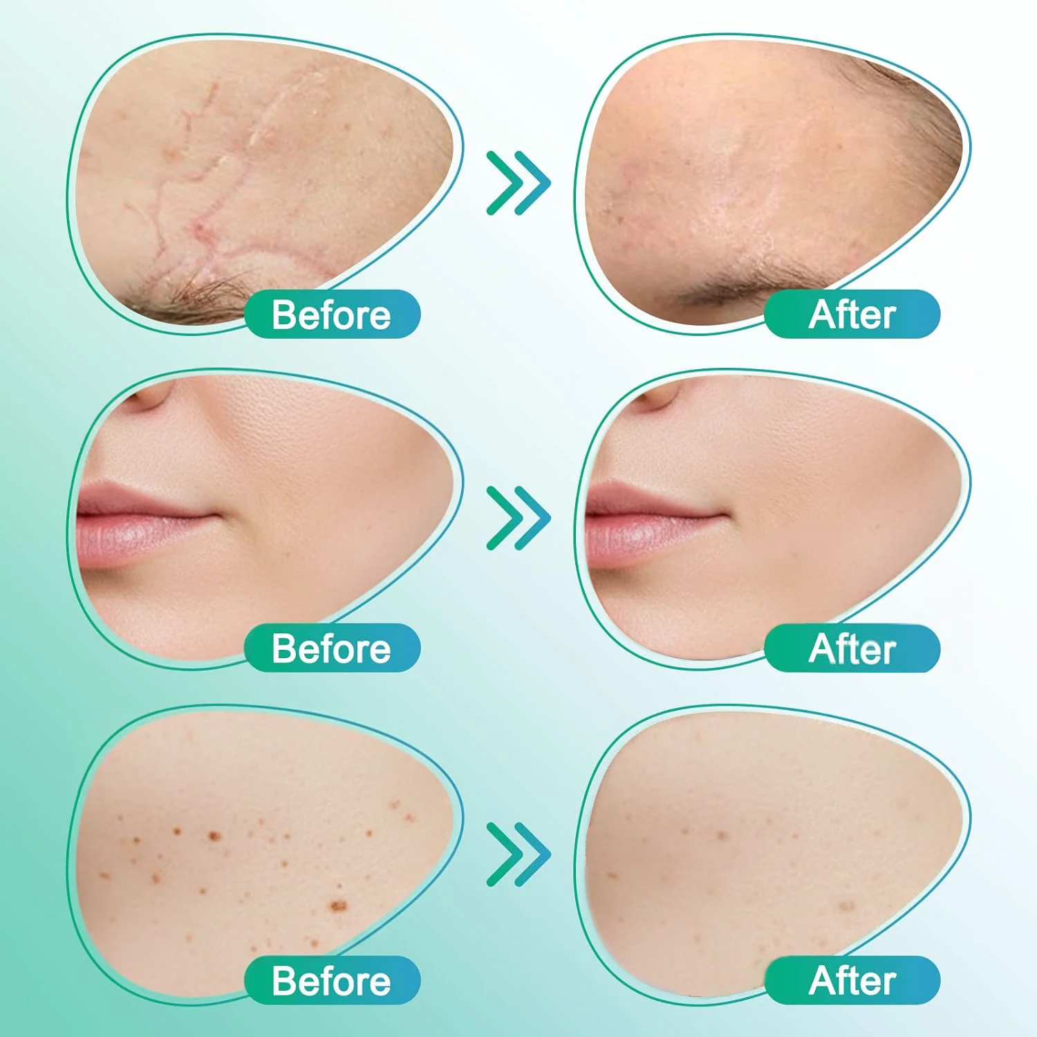✅ 𝗖𝗮𝗿𝗲𝗕𝗿𝗲𝗲𝘇𝗲® 3-in-1 Microneedle Care Patch - Image 3