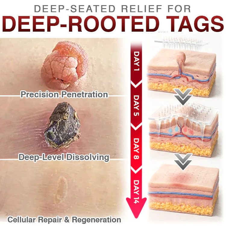 CareBreeze® Skin Tag Removal Micro-needle Patch - Image 6